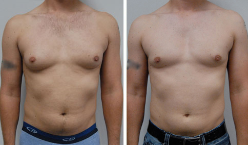 Steroid use after gynecomastia surgery