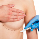 Four Need to Knows Before Breast Augmentation