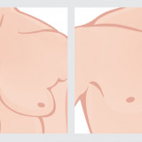 The 411 on Gynecomastia