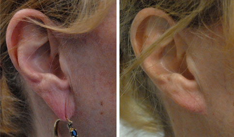 Ear lift on sale
