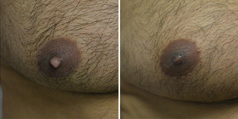 Nipple Reduction – Patient 110  Jonathan Hall, MD, FACSJonathan Hall, MD,  FACS