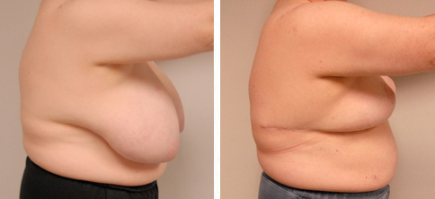 44 dd breasts discount