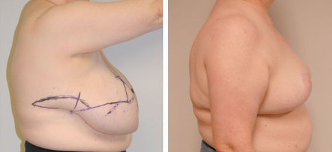 Breast Reduction Patient #125  Jonathan Hall, MD, FACSJonathan