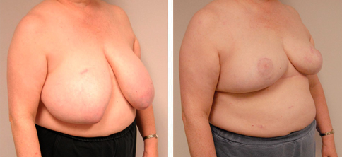 44 on sale dd breasts