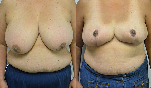 Breast Reduction – Patient 114  Jonathan Hall, MD, FACSJonathan