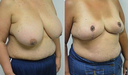 Breast Reduction – Patient 114  Jonathan Hall, MD, FACSJonathan Hall, MD,  FACS