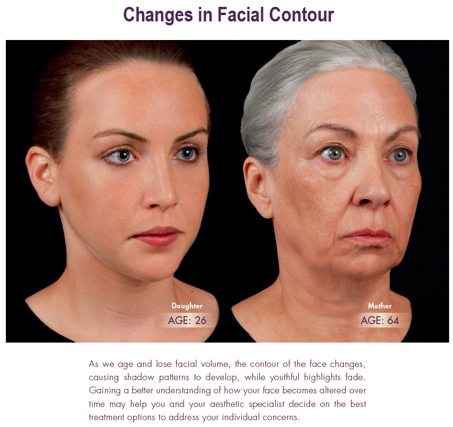 Facial Contouring with Botox