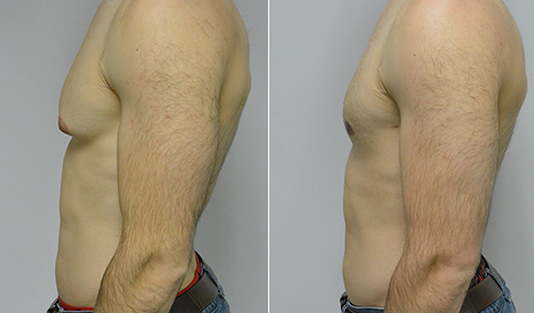 Gynecomastia Patient 38  Jonathan Hall, MD, FACSJonathan Hall, MD, FACS