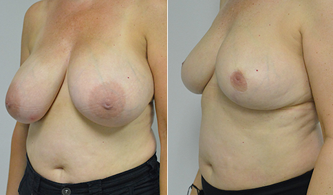 Breast Reduction- Patient 136  Jonathan Hall, MD, FACSJonathan Hall, MD,  FACS