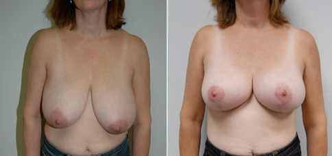 breast lift before and after boston