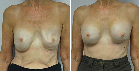 Breast Augmentation Revision – Patient 315  Jonathan Hall, MD,  FACSJonathan Hall, MD, FACS