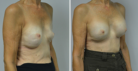 Breast Augmentation Revision – Patient 315  Jonathan Hall, MD,  FACSJonathan Hall, MD, FACS