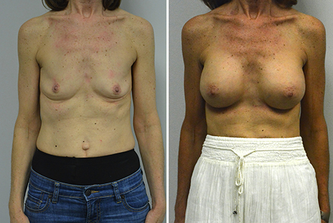 Breast Augmentation- Patient 243  Jonathan Hall, MD, FACSJonathan