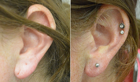 otoplasty before and after boston