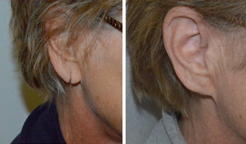 otoplasty boston ma