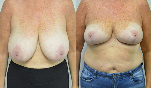 Breast Reduction – Patient 135  Jonathan Hall, MD, FACSJonathan Hall, MD,  FACS