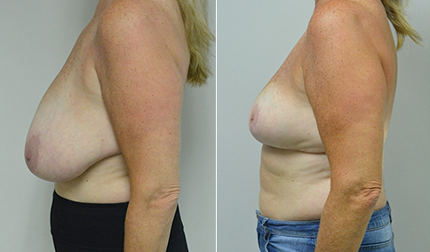 Breast Reduction Patient #125  Jonathan Hall, MD, FACSJonathan