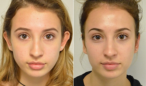 Otoplasty patient before and after