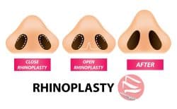 Rhinoplasty Blog