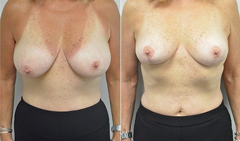 Breast Reduction Mastopexy Patient 143 Jonathan Hall MD