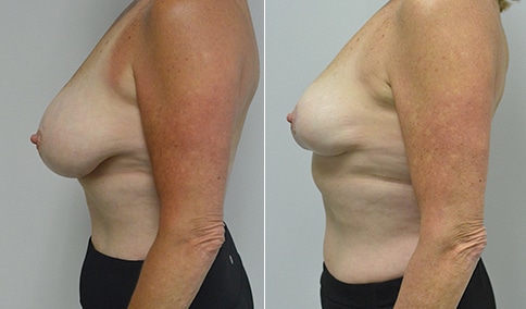 Breast Reduction/Mastopexy – Patient 143  Jonathan Hall, MD, FACSJonathan  Hall, MD, FACS