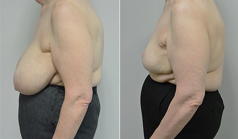 Breast Reduction Patient #125  Jonathan Hall, MD, FACSJonathan