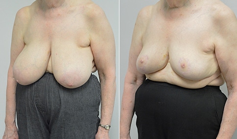Breast Reduction – Patient 142  Jonathan Hall, MD, FACSJonathan