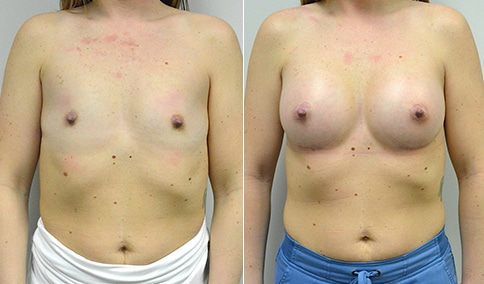 Breast Augmentation – Patient 273