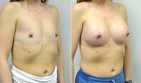 Breast Augmentation – Patient 273