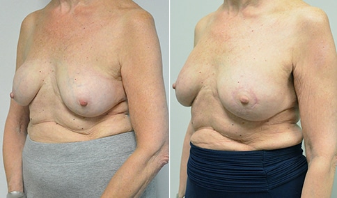 Breast Augmentation Revision – Patient 259