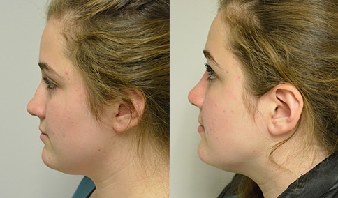 rhinoplasty