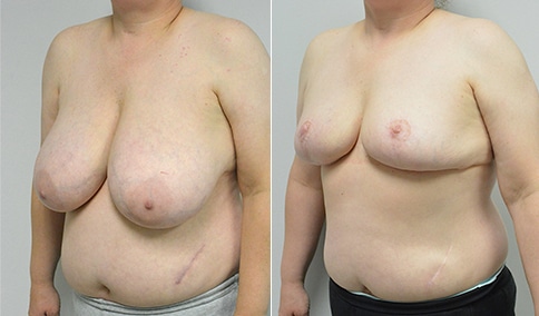 https://www.drjhall.com/wp-content/uploads/2018/04/Hall_Boston_Breast-Reduction-22-Left-OBL.jpg