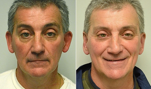 Otoplasty Patient Before and After