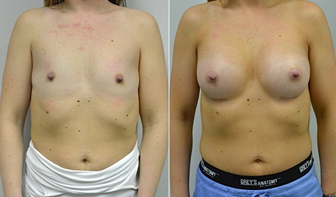 https://www.drjhall.com/wp-content/uploads/2018/05/Hall_Boston_Breast-Augmentation-37-AP.jpg