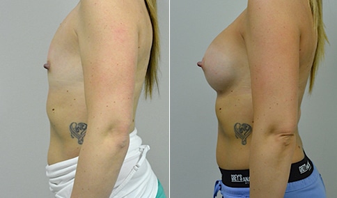 Breast Augmentation Before and After Pictures Case 123