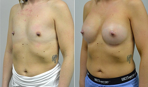 🥇 Will Breast Augmentation surgery help with Pigeon Chest Deformity?