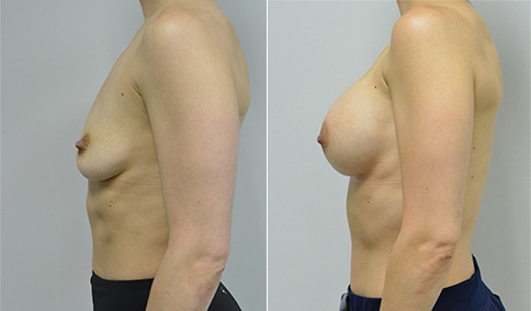 Breast Augmentation – Patient 280