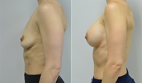 Breast Augmentation – Patient 280  Jonathan Hall, MD, FACSJonathan Hall,  MD, FACS