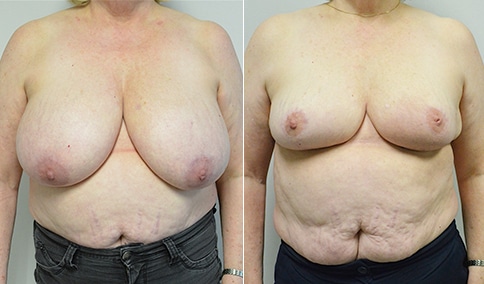 Breast Reduction – Patient 156  Jonathan Hall, MD, FACSJonathan Hall, MD,  FACS