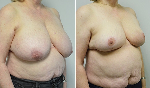 Breast Reduction 114  Jonathan Hall, MD, FACSJonathan Hall, MD, FACS