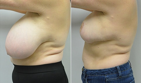 Gynecomastia Patient 38  Jonathan Hall, MD, FACSJonathan Hall, MD, FACS