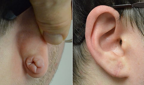 Poughkeepsie Earlobe Repair Poughkeepsie Gauge Earring Surgeon