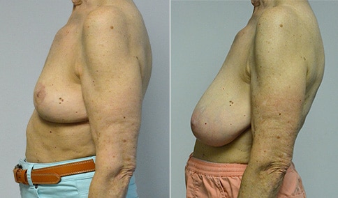 Breast Reduction – Patient 170  Jonathan Hall, MD, FACSJonathan