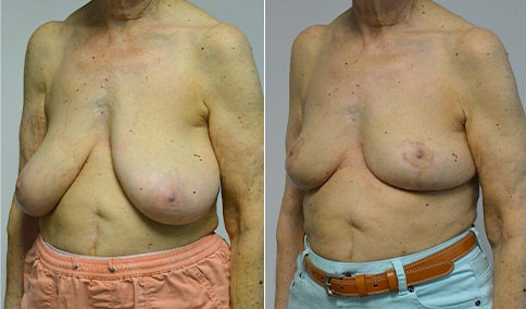 Breast Reduction – Patient 113  Jonathan Hall, MD, FACSJonathan Hall, MD,  FACS