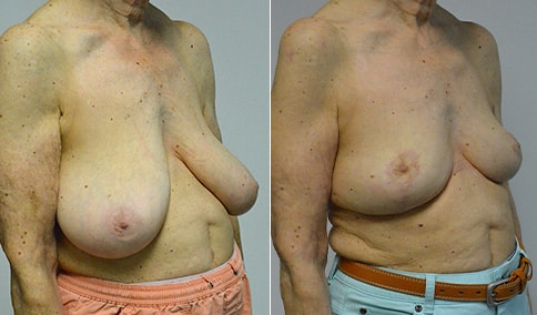 Breast Reduction Patient 120  Jonathan Hall, MD, FACSJonathan