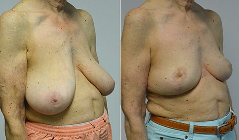 Breast Reduction 114  Jonathan Hall, MD, FACSJonathan Hall, MD, FACS