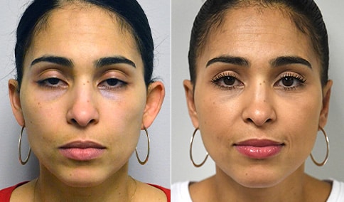 otoplasty patient