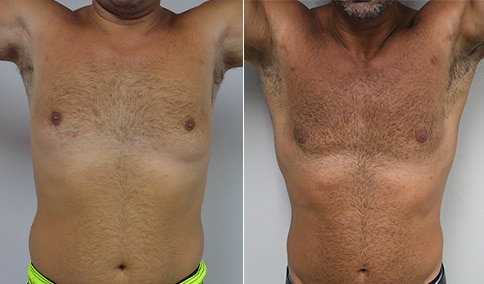 Gynecomastia Patient 38  Jonathan Hall, MD, FACSJonathan Hall, MD, FACS