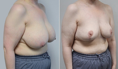 Breast Reduction – Patient 174  Jonathan Hall, MD, FACSJonathan