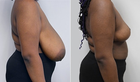 Breast Reduction & Asymmetry Patient – 175